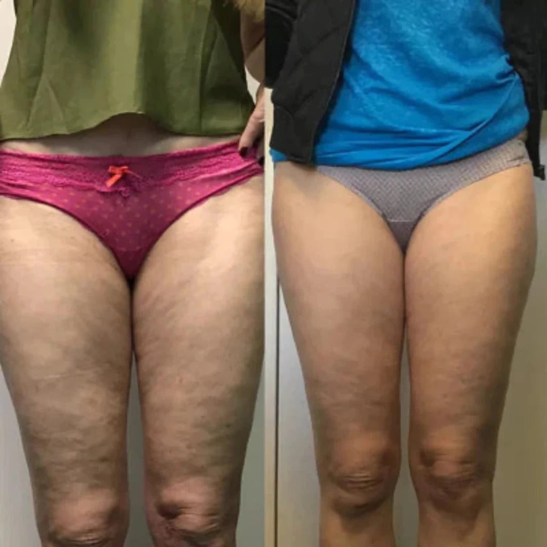 Vacutone Sculpt and Smooth Pro™